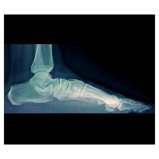Wall Art  Posters  Flat foot, X ray Poster